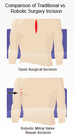 Traditional vs. robotic surgery incision